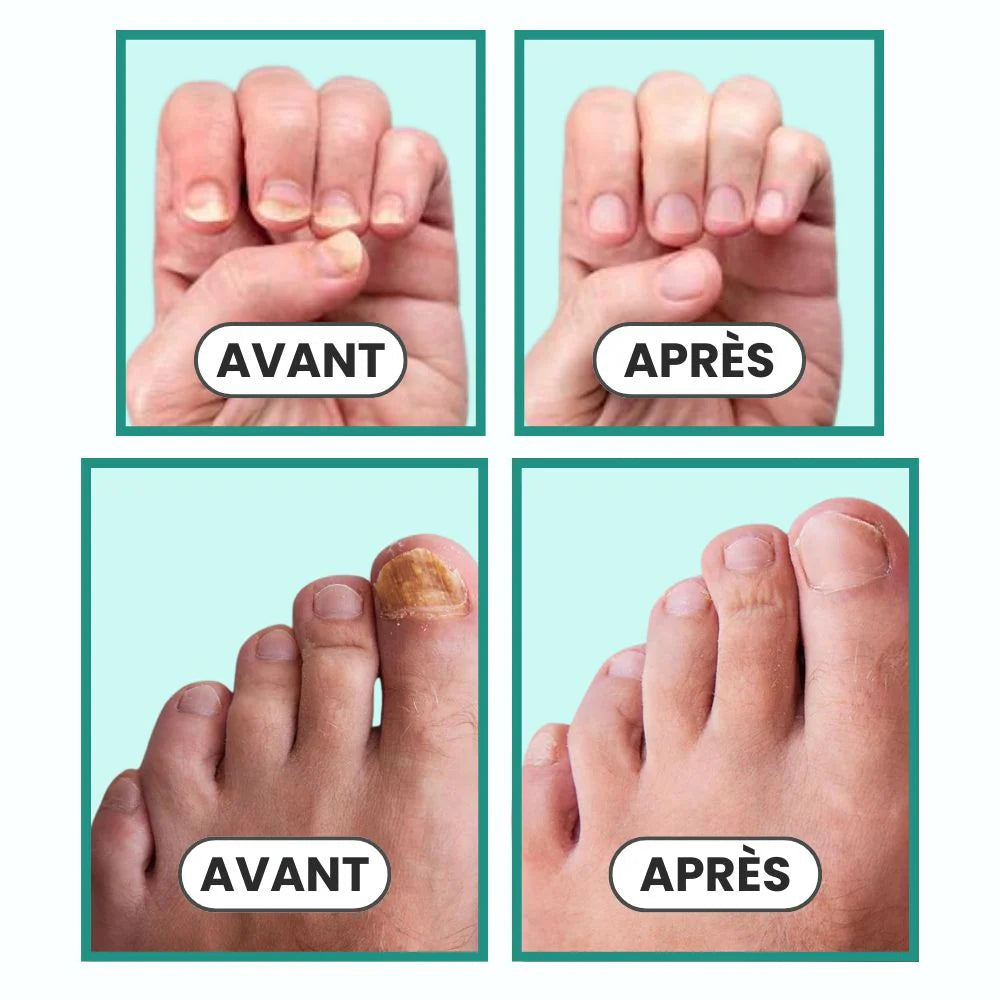 Appareil de traitement des mycoses