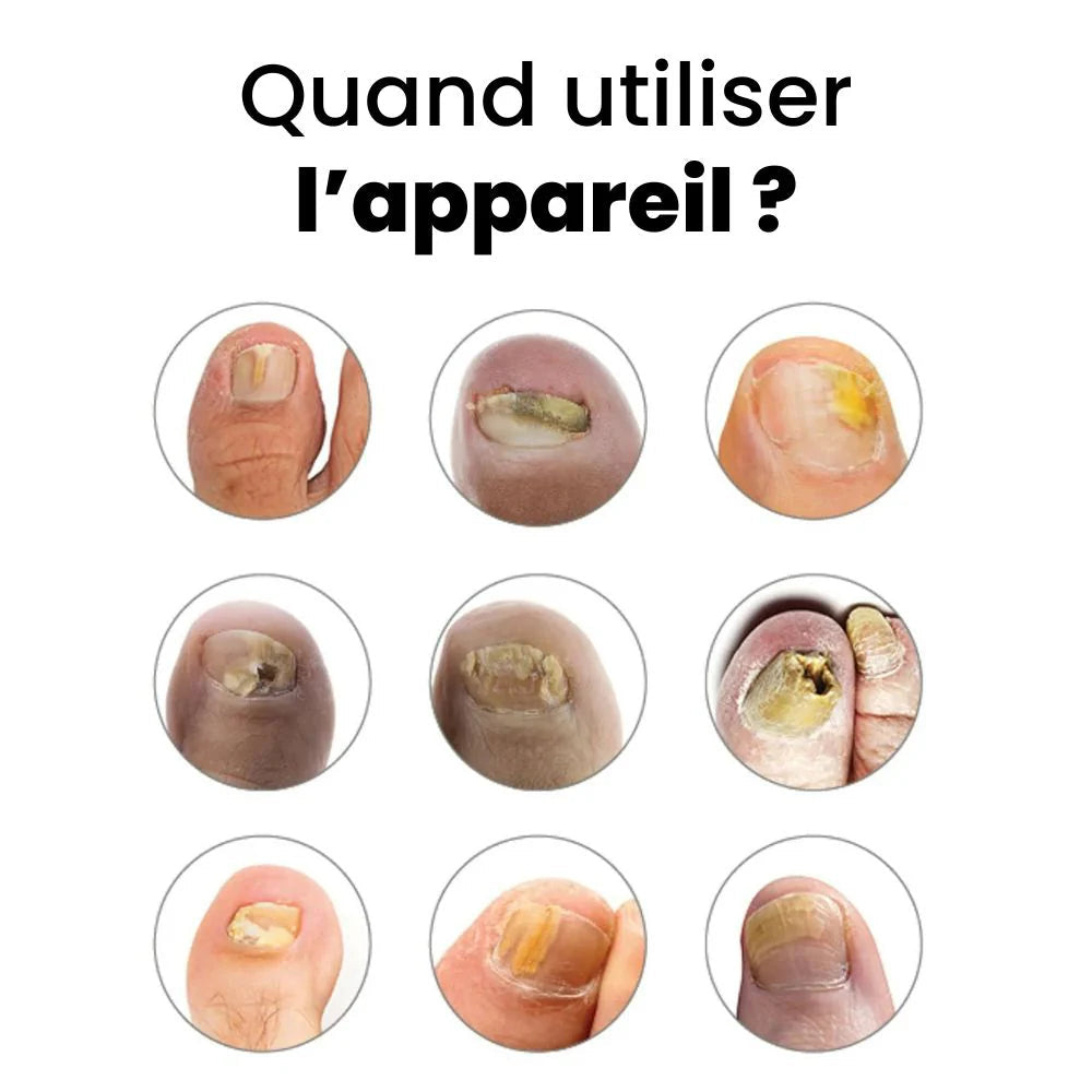 Appareil de traitement des mycoses